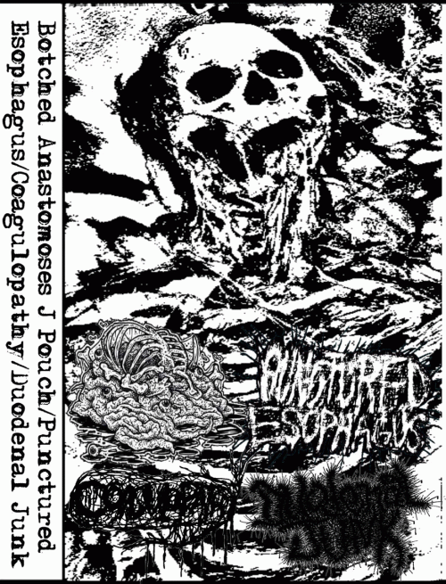 Botched Anastomosis J-Pouch : Botched Anastomosis J-Pouch - Punctured Esophagus - Coagulopathy - Duodenal Junk